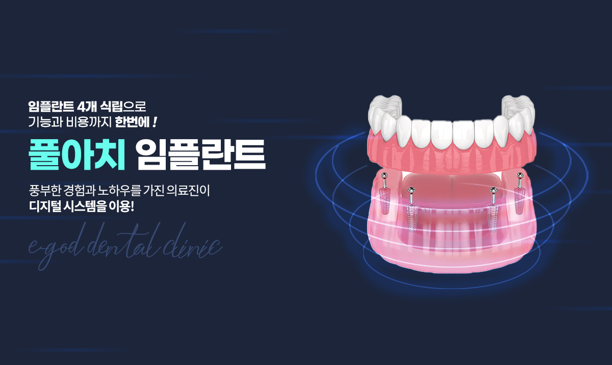 풀아치 임플란트